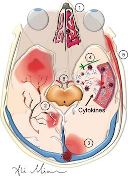 Cyrus Raji blog: Uncovering the Long-term Neurological Ramifications of COVID-19