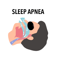 Sleep-Apnea